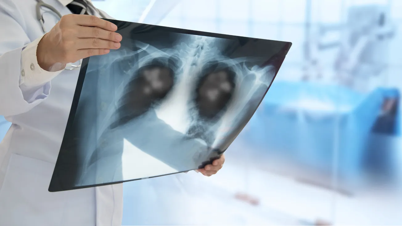 The Shocking Truth About “White Lung Disease”: Attorney Tom Renz